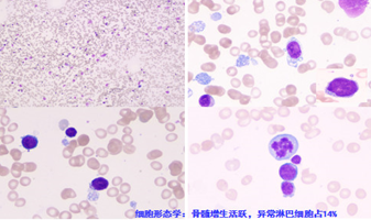 How Did We Successfully Treat Advanced Diffuse Large B-cell Lymphoma with Sequential Multi-target CART Therapy?